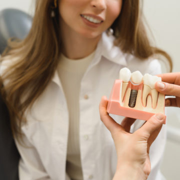 Implants dentaires : les avantages pour le remplacement de dents