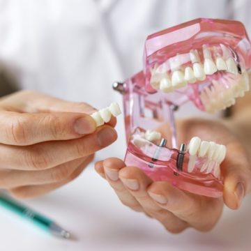 Implants dentaires : les options pour remplacer les dents manquantes