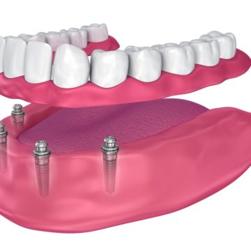 Prothèse dentaire sur implants : un choix judicieux