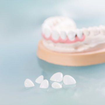 Facettes dentaires : le secret d’un sourire éclatant
