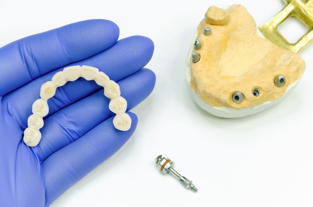 Une prothèse sur implants en implantologie dentaire