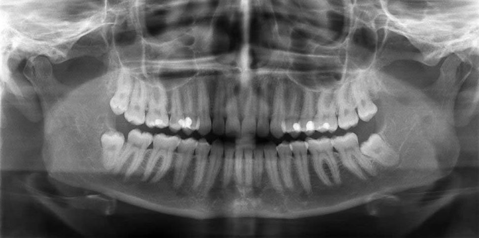 La radiographie panoramique