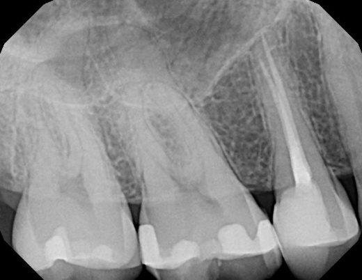 La radiographie périapicale