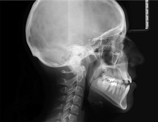 Une radiographie céphalométrique ou céphalogramme 