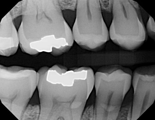 La radiographie interproximale