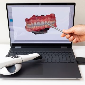 Les empreintes optiques utilisées pour la simulation Invisalign