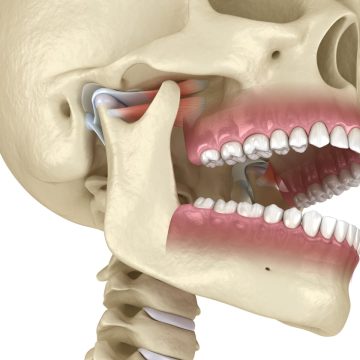 Une mauvaise occlusion affecte l'ATM et le fonctionnement des mâchoires.