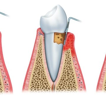 Illustration des stades de la parodontite