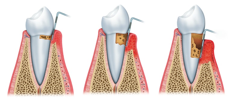 Illustration des stades de la parodontite