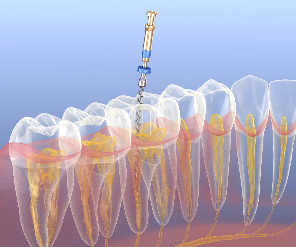 Illustration 3D d'un traitement de canal