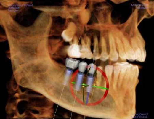 Les tomographies volumiques à faisceau conique Les tomographies volumiques à faisceau conique